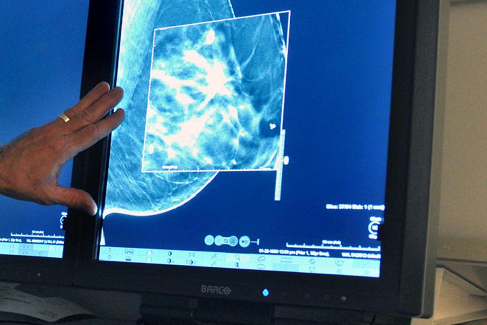 Study Questions On Early Treatment Of Stage 0 Breast Cancer