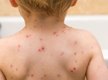 Chickenpox Virus Is A Seasonal Disease: Study