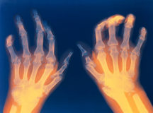 Rheumatoid Arthrities Found To Have Direct Link With Heart Disease