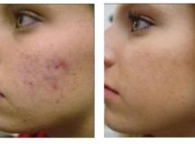 Acne Scar Removal with Chemical Peels