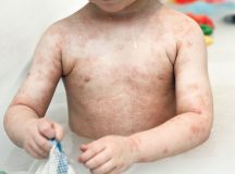 How to Treat Childhood Atopic Dermatitis
