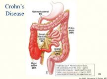 Inflammatory Bowel Disease – Looking at Crohn’s